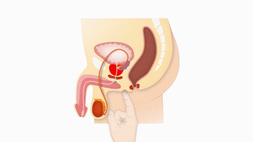 Prostatamassage